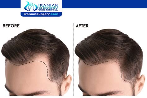 Unshaven Fue Hair Transplant Hair Transplant Without Shaving Head