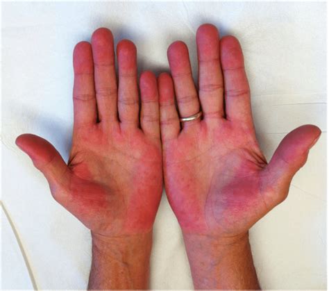 Palmar Erythema What It Is Causes Pictures Treatment