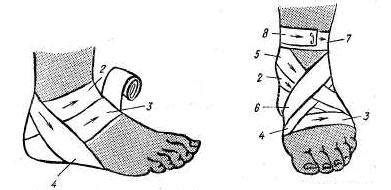 Повязки на нижнюю конечность - Десмургия - Хирургические болезни ...