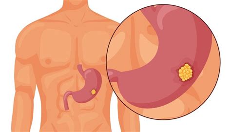 Cancer De L estomac Tumeur Cancéreuse Maligne Illustration Vectorielle