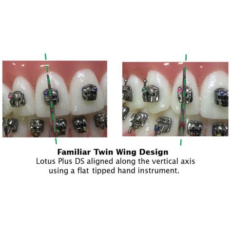 Lotus Plus DS Hybrid Patient Kits Ortho Technology S Version Of