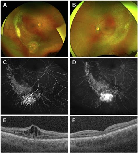 Vasoproliferative Tumor In X Linked Retinoschisis Ophthalmology Retina