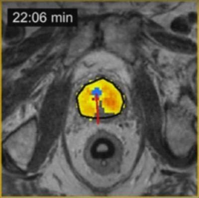 Ultrasound Ablation Of The Prostate With A Help Of Tulsa Pro System