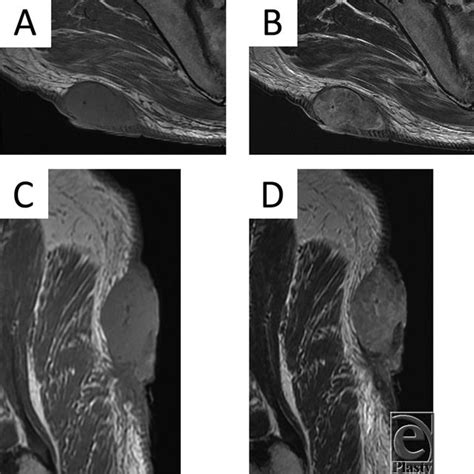 A Axial T1 Weighted MRI Scan Of The Tumor B Axial T2 Weighted MRI