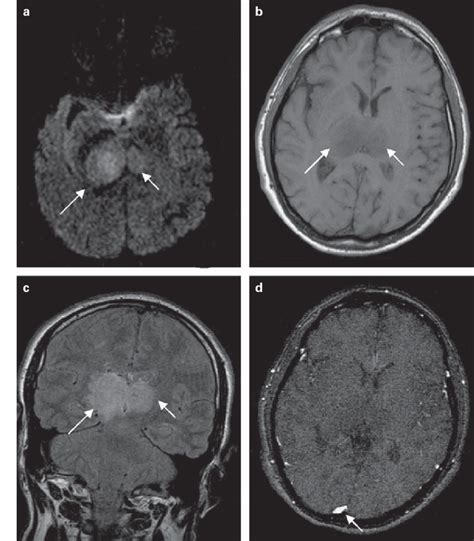 Differential Diagnosis Of Bilateral Thalamic Lesions Pdf Download