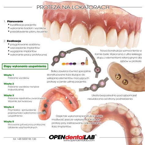 Proteza Na Lokatorach Na Implantach Ze Wzmocnieniem Open Dental Lab