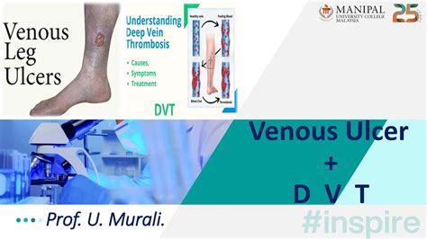 Venous Ulcer And Deep Vein Thrombosis Causes Management Ppt