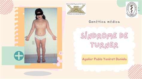 Síndrome De Turner Yaniret Aguilar Udocz