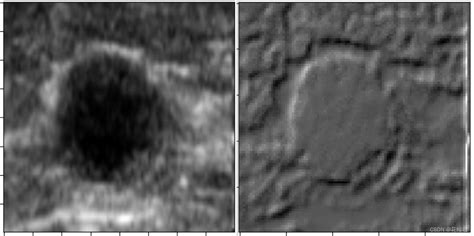 【机器学习】乳腺肿瘤超声图像二分类 利用小波变换和自相关系数超声图像 小波变换 Csdn博客