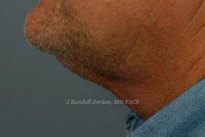 Neck Lift Archives Faces Pllc In Ridgeland Ms