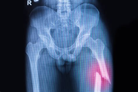 Closed Femur Fracture