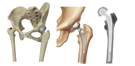 Joint Replacement | Dr. Joseph's Ortho Clinic | Orthopedic Clinic | Thanjavur | Tamilnadu - India.