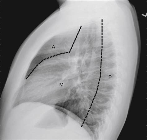 Mediastinal Masses Clinical Tree