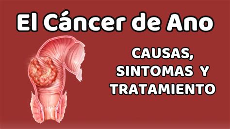 EL CÁNCER DE ANO Causas signos y síntomas diagnóstico y tratamiento