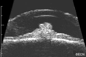 Case #1: Iris Melanoma or Iris Melanocytoma? » New York Eye Cancer Center