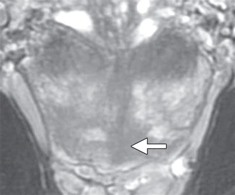 Imaging Guided Prostate Biopsy Conventional And Emerging Techniques Radiographics