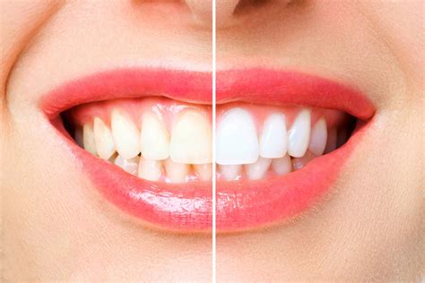 The Step By Step Guide To Professional Teeth Whitening