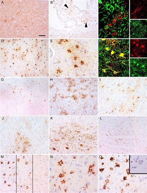 Neuropathological Observations In Genetic Cjd V I Immunostaining