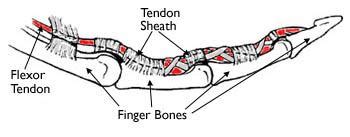 Flexor Tendon Injuries - Mendelson Kornblum