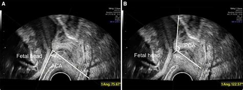 Frontiers Nomogram Based On The Final Antepartum Ultrasound Features