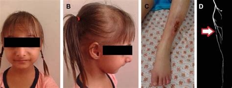 Seckel syndrome, causes, symptoms, diagnosis, treatment & life expectancy