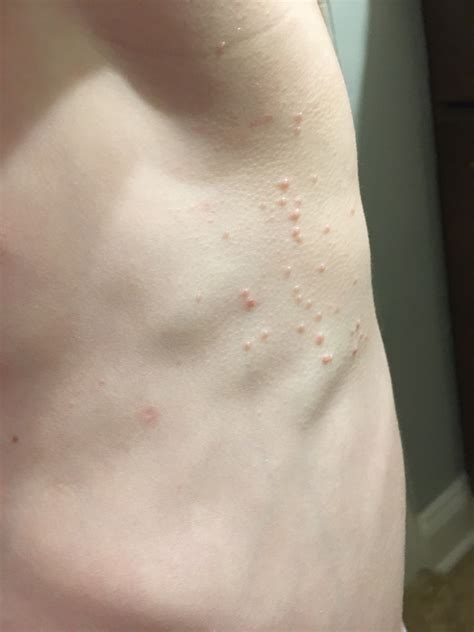 Molluscum Contagiosum Virus