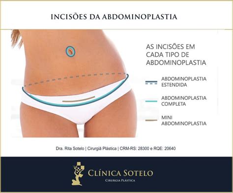 Abdominoplastia E Mini Abdominoplastia Qual A Diferen A Lajeado Rs