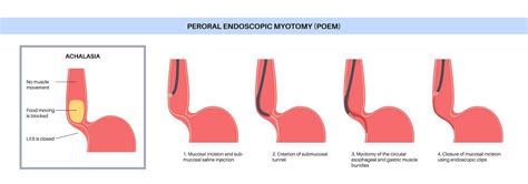 Premium Vector | Peroral endoscopic myotomy POEM minimally invasive procedure Disorder of the ...