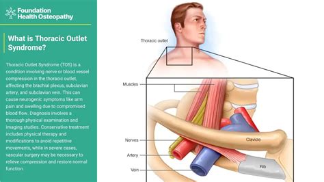 Thoracic Outlet Syndrome Foundation Health Osteopathy 02 6681 6249