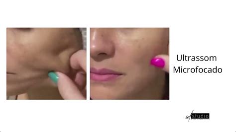 Ultrassom Microfocado Veja Como Funciona O Combate à Flacidez E O Lifting Em 1 Sessão Youtube