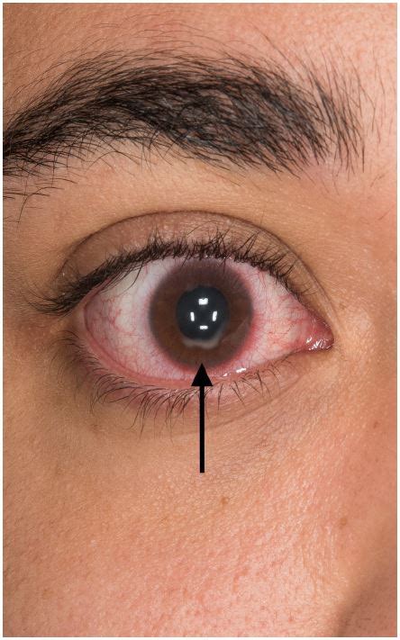 A Cloudy Conical Cornea The Western Journal Of Emergency Medicine