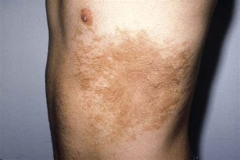 Hypertrichosis Journal Of The American Academy Of Dermatology