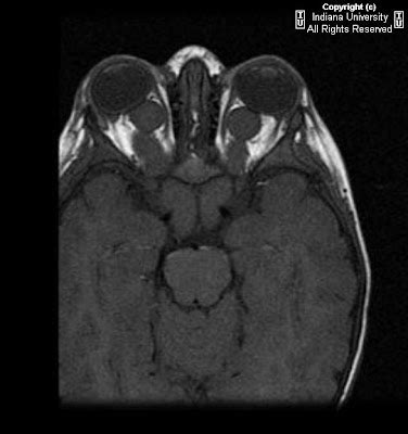 Neuroradiology On the Net: Bilateral optic nerve glioma