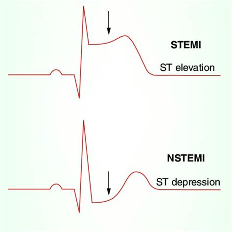 Time Course Of Cardiac Troponin Elevation As It Relates To The Size Of