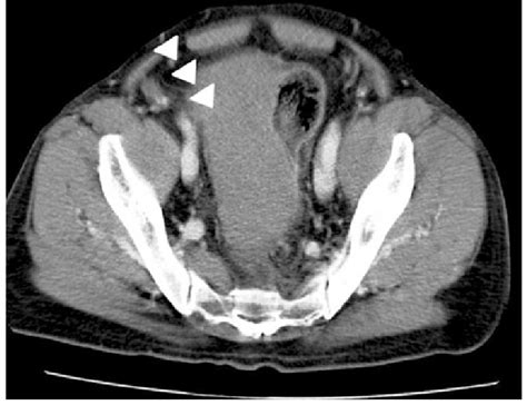 Abdominal Ct Scan Showing A Huge Hematoma In The Sigmoid Colon