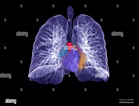 CT Chest Or Lung 3D Rendering Image With 3D Heart For Diagnosis TB