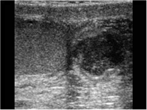 Epididymal Abscess Ultrasound