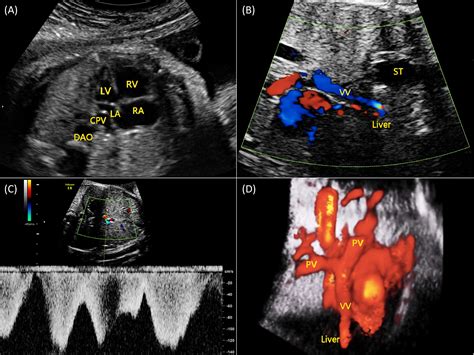 Prenatal Diagnosis Of Total Anomalous Pulmonary Venous Connection By D