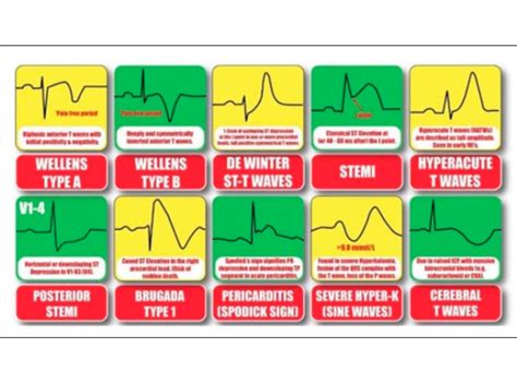 Important Abnormal T waves. - Perfusfind