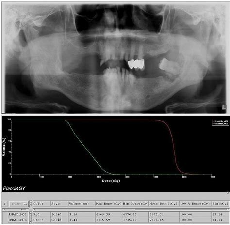 Figure 1 From Radiographic Osteoradionecrosis Of The Jaw With Intact