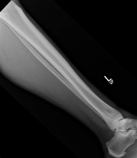 Fungal Osteomyelitis Image