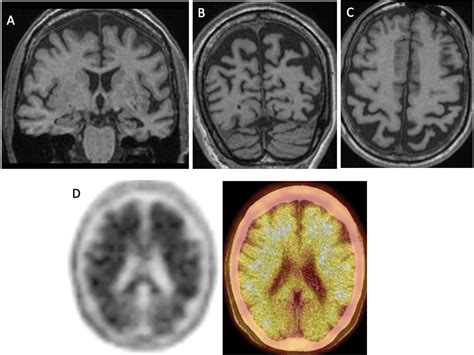 Amyloid Pet Imaging In Clinical Practice Practical Neurology