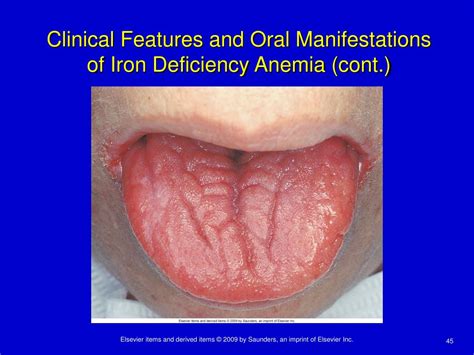 Iron Deficiency Anemia Tongue