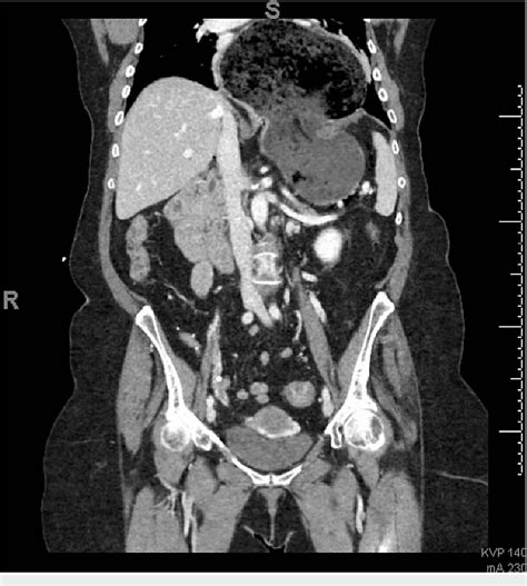 Figure 1 From Massive Hiatal Hernia With Acute Gastric Volvulus Masked As A Suspected Food