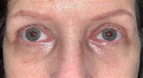 7 Upper Eyelid Surgery Before And After Photos Dallas Plano Texas Cosmetic Reconstructive