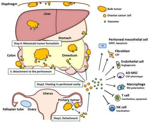 Ovarian Cancer Diagram