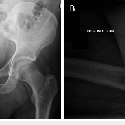 Post Operative Anteroposterior A And Lateral B Radiographic Views