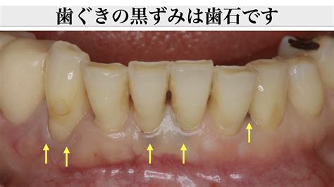 歯周ポケットの奥まで歯石除去してもらっていますか？｜スケーリングルートプレーニング