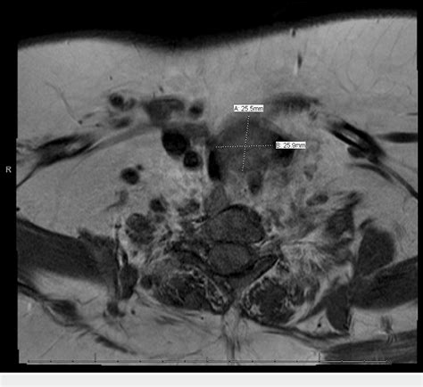 Figure 1 From Giving Voice To Cardiovocal Syndrome A 26 Year Old Woman