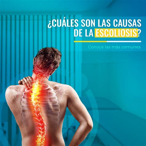 Escoliosis Síntomas Causas Y Tratamiento Fisiofocus